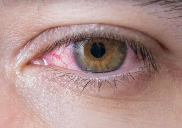“Red Eyes in the Elderly: Causes and Management Tips”