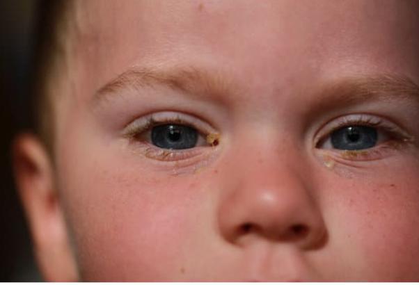 “How to Help Relieve the Symptoms of Pink Eye in Children – Conjunctivitis Treatment”
