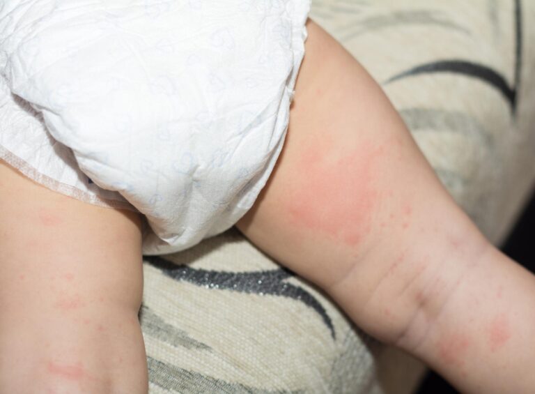 5 Essential Tips for Preventing Diaper Rash: A Parent’s Guide by Unified Caring